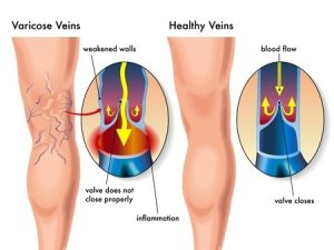 varicose veins